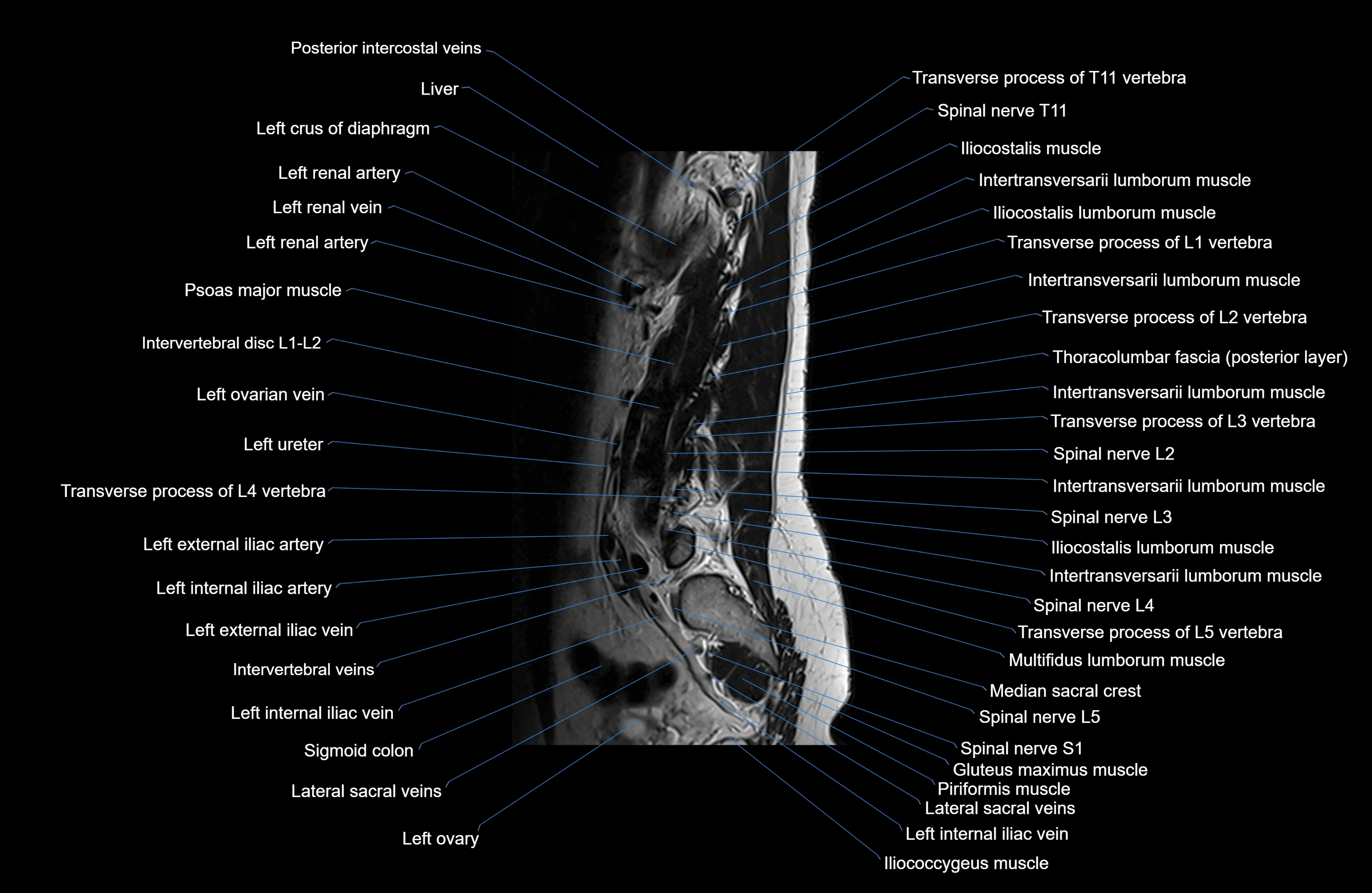 MRI lumbar spine sagittal cross sectional anatomy 3T radiology  image-img-00001-00023.webp
